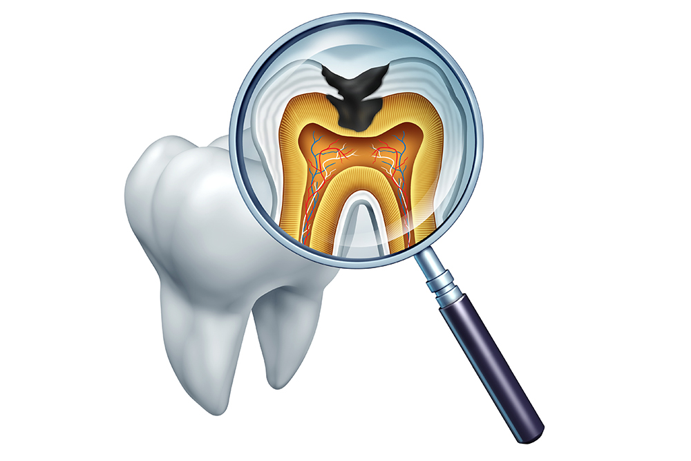 重度の虫歯は根管治療で治します