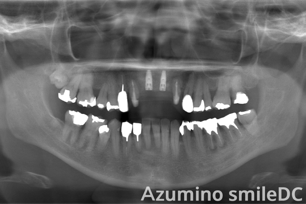 GBRインプラント埋入直後レントゲン撮影