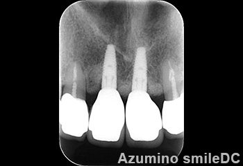 補綴後レントゲン