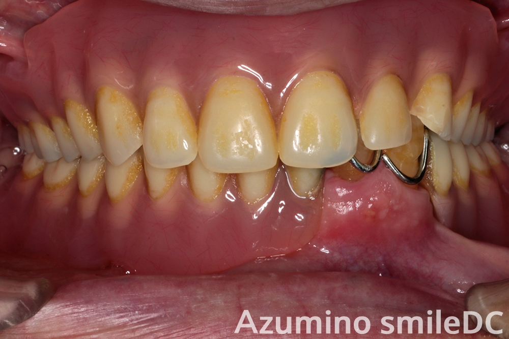 術前義歯装着写真