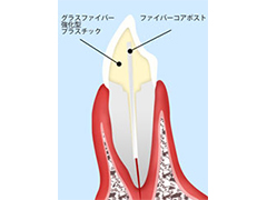 ファイバーコア（土台）