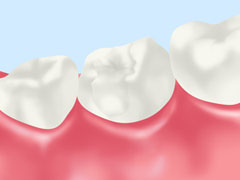オールセラミック（詰め物・被せ物）