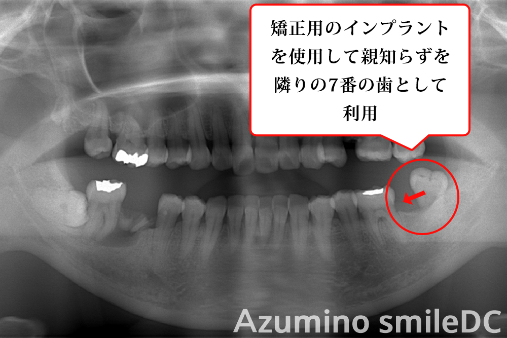 インプラントMTM術前パノラマ