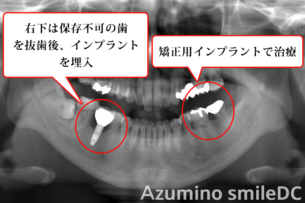 インプラントMTM、術後パノラマ