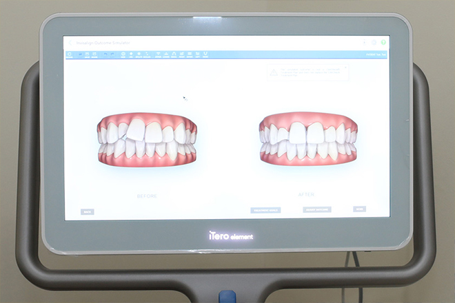 当院のインビザラインファーストの治療は口腔内スキャナーを活用しま