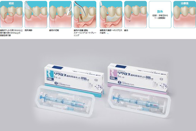 歯周組織再生療法とは？