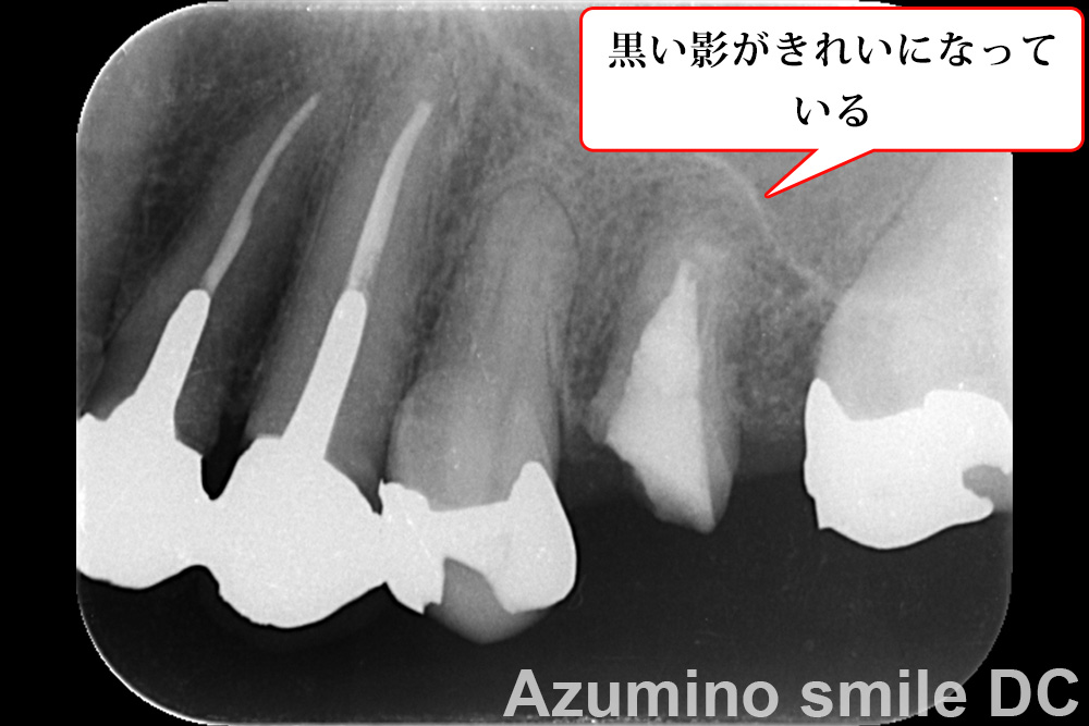 術後レントゲン