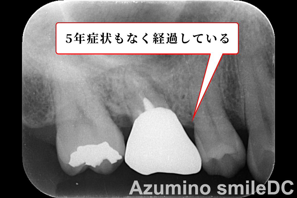 5年経過後レントゲン