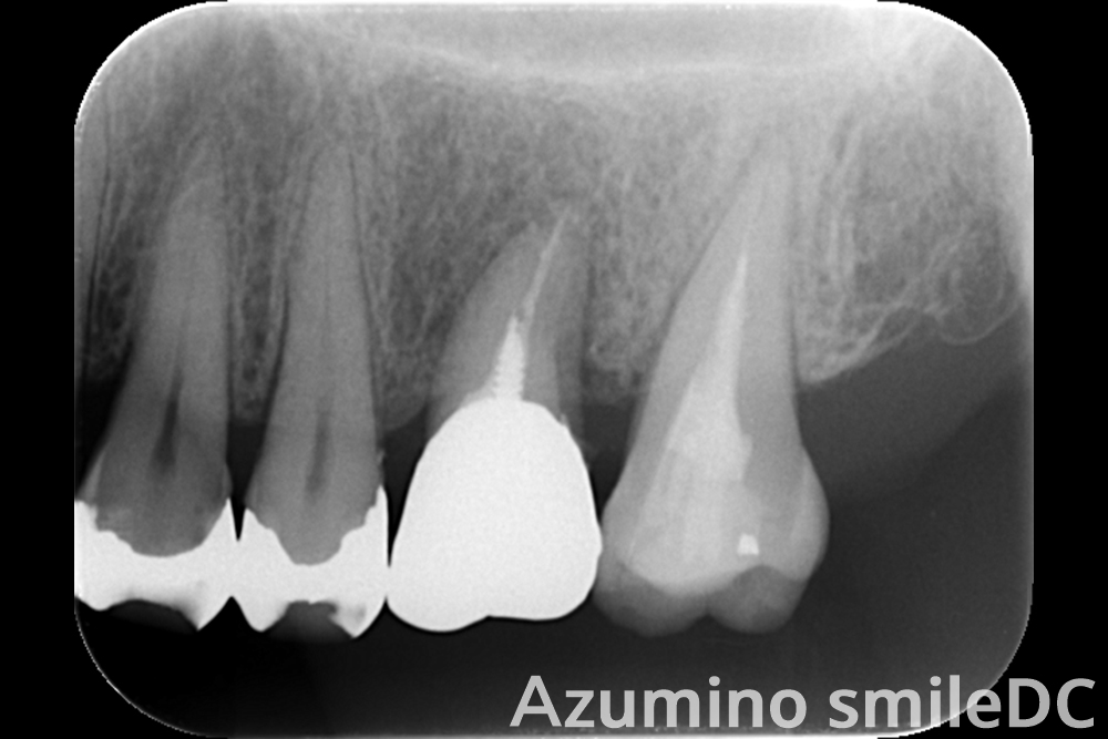 術後補綴後レントゲン