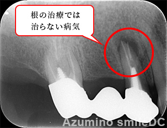 術前レントゲン