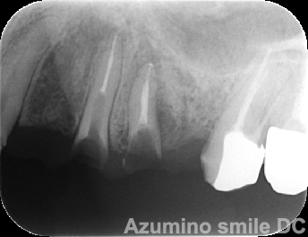 術前レントゲン（骨に埋まるほどの虫歯）